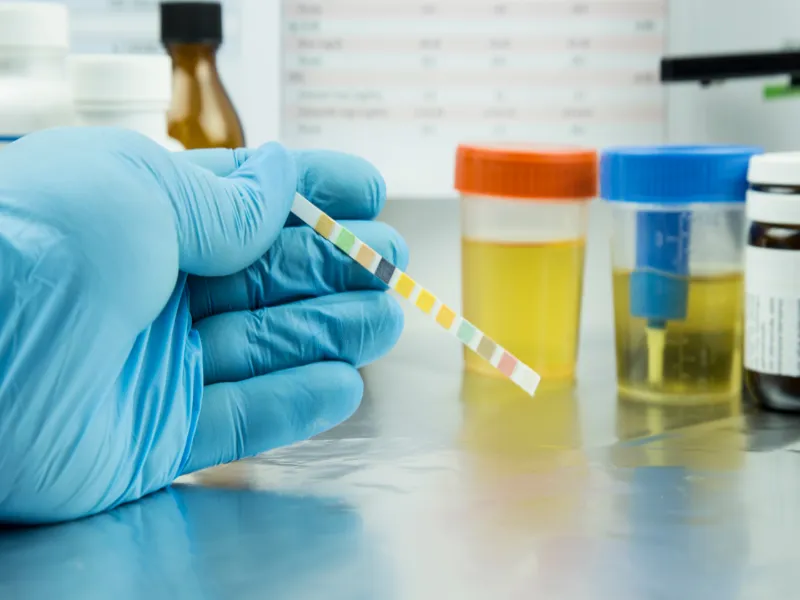 Ogólne badanie moczu – analiza i wyniki